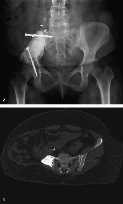 A Patient With An Iliosacral Giant Cell Tumor With Reconstruction Download Scientific Diagram