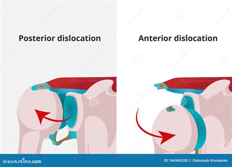 Anterior And Posterior Shoulder Dislocation Vector Illustration Stock Vector Illustration Of