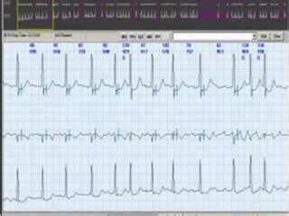 Holter De Ritmo Cardiaco Cardiolink