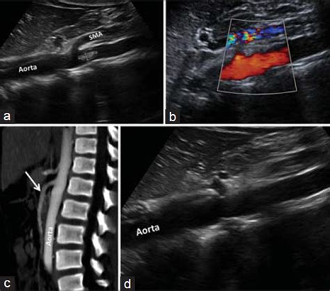 Superior Mesenteric Artery-Related Aortic Pseudomass as a Form of ...