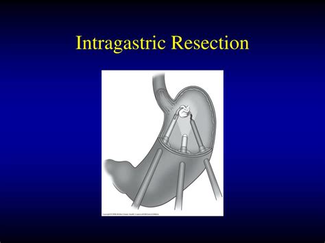 Ppt Laparoscopic Gastric Resections Powerpoint Presentation Free