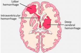 Path Block Sdl Cerebrovascular Disease Ii Intracerebral And