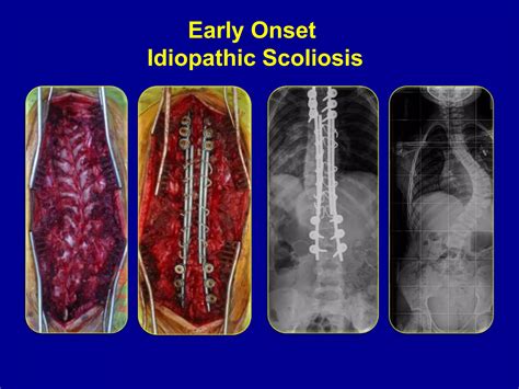 Early Onset Scoliosis Ppt