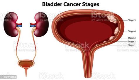 Vektor Tahapan Kanker Kandung Kemih Ilustrasi Stok Unduh Gambar