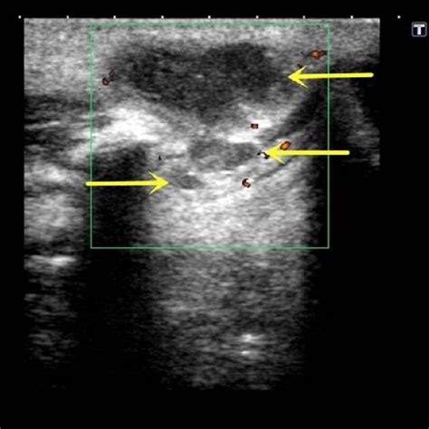 Preoperative Color Doppler Ultrasonography Of The Tumor Showing 2