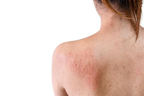 10 Most Common Types Of Skin Rashes Daily Health Valley Images Nbkomputer