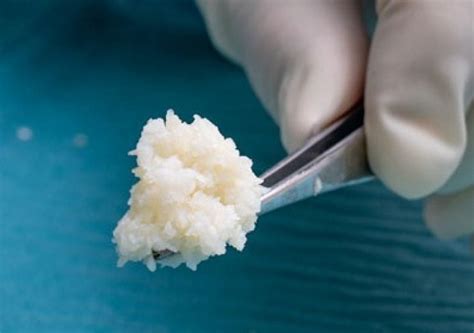 Kerecis Introduces New Easy To Use Fish Skin Graft