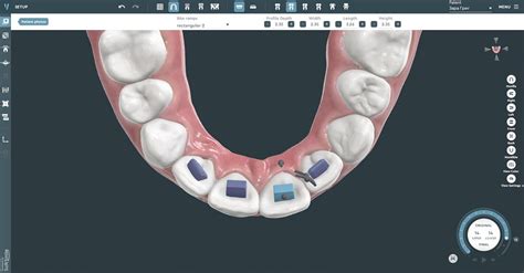 Dental 3D Modeling Software | Orthodontic CAD Software