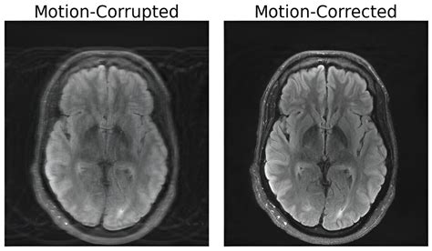 Researchers Combine Deep Learning And Physics To Fix Motion Corrupted