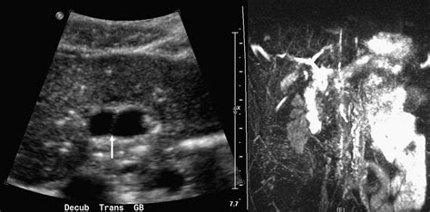 Gallbladder Duplication Evaluation Treatment And Classification