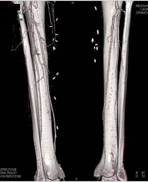 Dual Energy Runoff Study Comparing De With Routine Bone Editing In