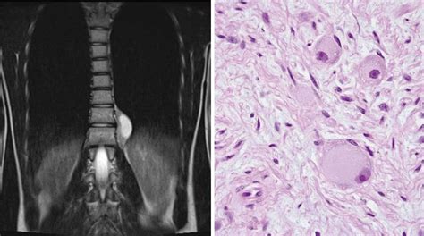 Magnetic Resonance Imaging At Presentation And Histological Examination