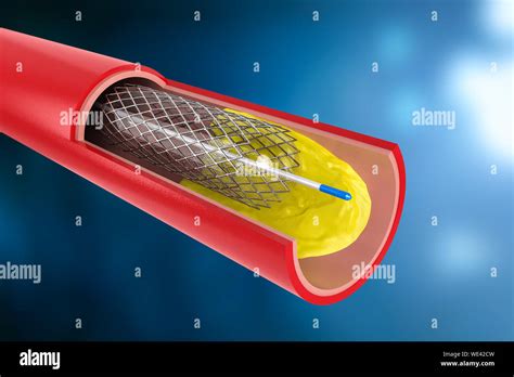 Angioplastie de stent coronaire Banque de photographies et dimages à