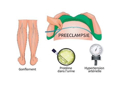 Prééclampsie Chez La Femme Enceinte Information Hospitalière Lexique Et Actualité Du Milieu