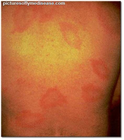 lyme disease rash photos - pictures, photos