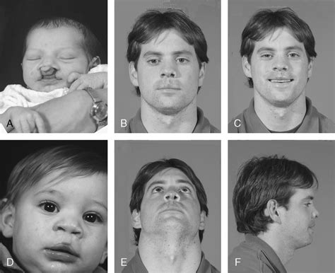 Completed Patient 6 A Preoperative Bilateral Complete Cleft Lip Nose Download Scientific