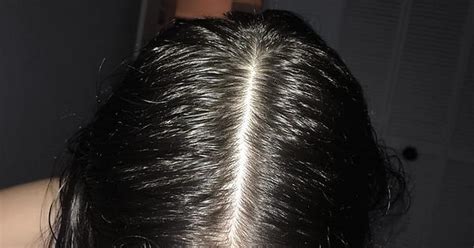 Hair Regrowth Progress Album On Imgur