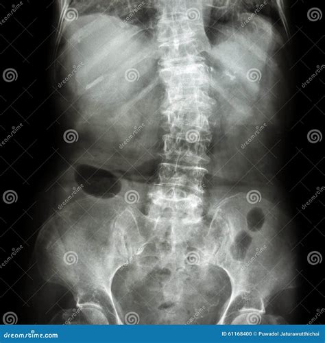 Espondilosis Y Escoliosis Lumbar De La Radiograf A De La Pel Cula