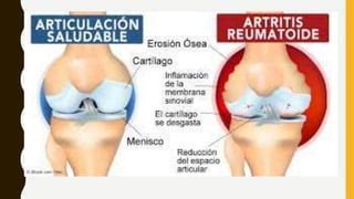 Artritis Y Artrosis Ppt