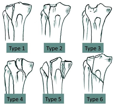 Applied Sciences Free Full Text Influence Of The Screw Positioning