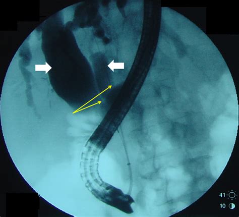 ERCP Showing Type Va Extrahepatic Bile Duct Duplication Right And Left