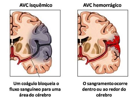 O Processo de Recuperação de Um AVC Saúde Cultura Mix