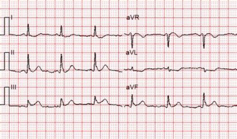 Acute Stemi Ekg