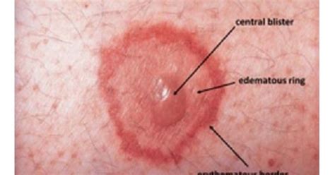 Target Lesion Rashes Erythema Migrans And Erythema 60 Off