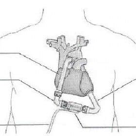 Schematic representation of LVAD application | Download Scientific Diagram