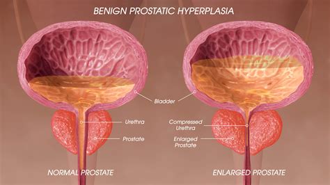 Prostate Enlargement Expert Ir Neuro And Vascular Clinic