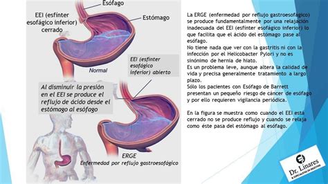 Reflujo Gastroesof Gico Cl Nica Dr Linares