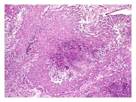 Photographs Of Malignant Epithelioid Mesothelioma Hematoxylin Eosin