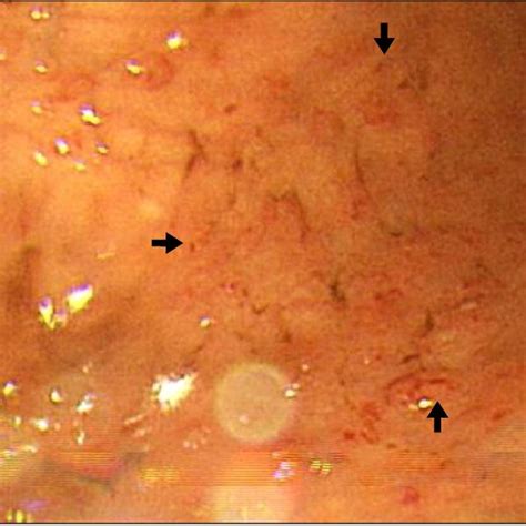 Esophagogastroduodenoscopy Multiple Small Elevated Mucosal Ulcerations Download Scientific