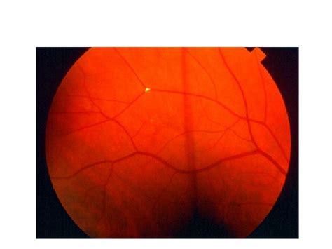 Stanford Medicine 25 Fundoscopy Papilledema Fundoscopic Findings Venous