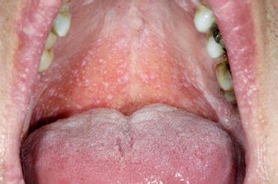 Reticular Oral Lichen Planus