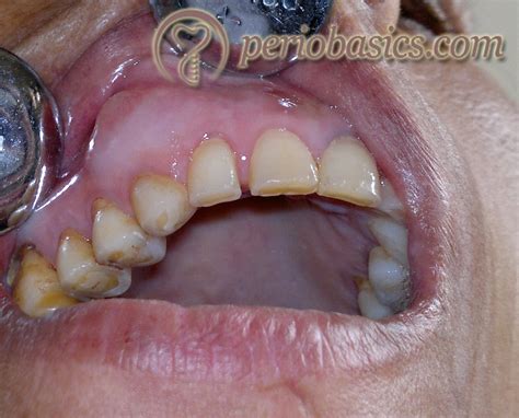 Gingival Enlargement Clinical Periodontology