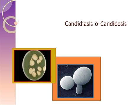 Candidiasis Sanchez Jose Udocz