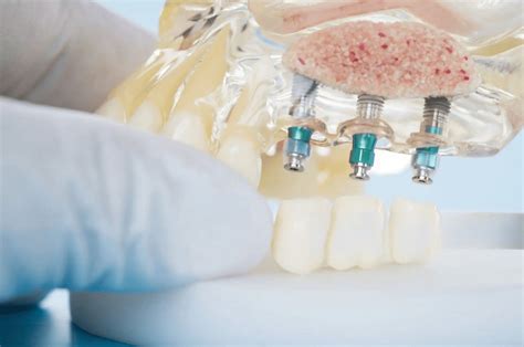 Implantologia Parma Prezzi Costi E Soluzioni Dentali Implantologia