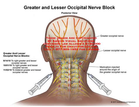 Amicus Illustration Of Amicus Medical Greater Lesser Occipital Nerve Block Medication Origin