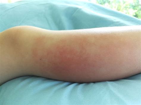 What Is Cellulitis? | Cellulitis treatment, Essential oils, Oregano ...