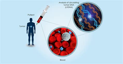 For Stage 2 Colon Cancers Circulating Tumor Dna May Reduce Unnecessary