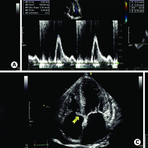 Typical Echocardiography Features In Cardiac Amyloidosis Patients A