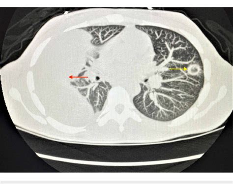 Reformatted Ct Chest Without Contrast Showing Right Sided Loculated