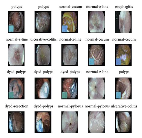 Samples of endoscopy images of the gastroenterology data set (a) before ...