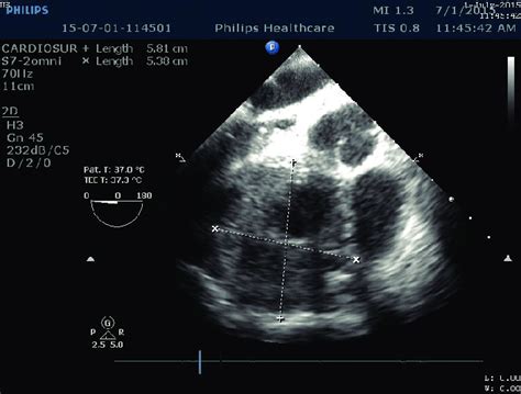 Preoperative Echocardiography Transthoracic And Transesophageal