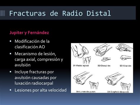 Fracturas De Radio Distal Generalidades