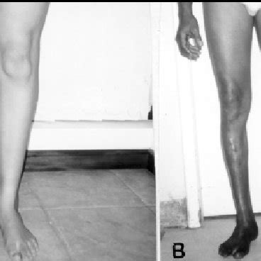 A Case Wasting Of Muscles Of Right Leg B Case Atrophy Of