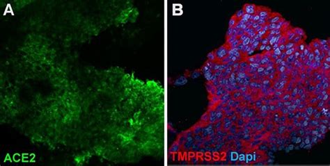 In Vitro Differentiation Of Human Ips Cells Into Airway Epithelial Lung