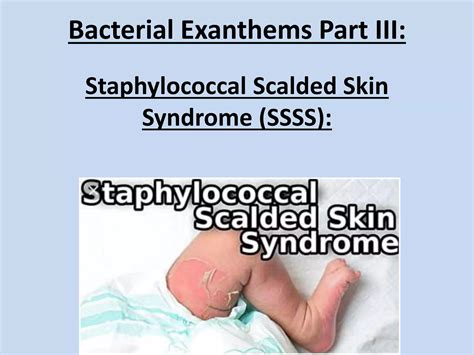 Staphylococcal Scalded Skin Syndrome Made Very Easy Ppt