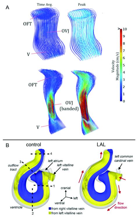 Blood Flow Velocity Streamlines In Normal And Defected Embryonic